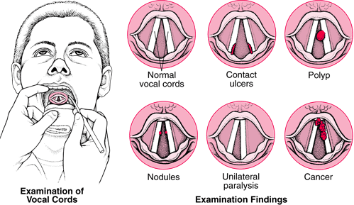 What is a throat nodule?